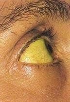 Yellow discoloration of tissue (from bilirubin deposition >3.0 mg/dl). Sclera and underneath tongue = most import places. 

Sources= normal RBC death (majority), destroyed RBCs,  hemoproteins (myoglobin, cytochromes)