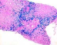 This is a liver stained with Prussian Blue. What disease is shown here? 

What is the inheritance, and what demographic is affected?