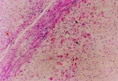This is a biopsy of a liver stained with A1AT. Describe the pathogenesis of this condition and what two major organs it affects.