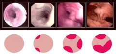 What action would be appropriate if you found no evidence of varices on upper endoscopy?

What if someone had a grade I (2nd panel) varices?