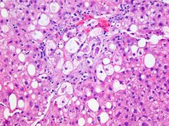 What histological finding is shown here?  Is it specific to any condition?