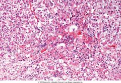 Does acute viral hepatitis cause portal or lobular inflammation? What about chronic viral hepatitis? 

What are changes seen in Acute viral hepatitis (shown here)?