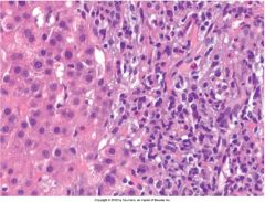 What cell type do you see in this predominate in this type of Hepatitis (hint: it is indistinguishable from chronic viral hepatitis)? 

What type of labs would it be appropriate to check in these patients?