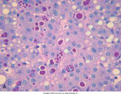 This person has a biopsy stained with PAS. What is the genetic defect? What is this person's genotype?

Besides liver conditions (cholestasis, cirrhosis, hepatitis), what is another frequent comorbidity in these pts?