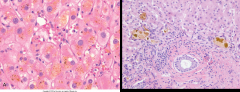 Jaundice (↑ Bilirubin), Pruritis (from ↑ bile acids), Skin xanthomas (accumulate cholesterol), ↑ Alk Phos, ↑ GGT 

Histology: enlarged hepatocytes, dilated canalicular spaces, apoptotic cells, Kupffer cells filled with bile pigment