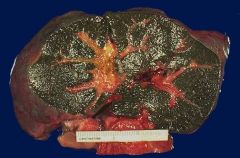 This is the liver of a newborn that had severe jaundice, dark urine, light (acholic) stools, and an enlarged liver. 

What changes might you suspect on the histology?
