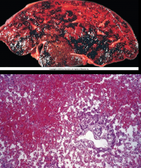 What acute condition is demonstrated here (on gross pathology and histology)? 

What other liver conditions can it look like? What would the chronic form of this condition look like?