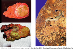 What type of malignant tumor is this? Name an infectious cause, a food contaminant cause, and a metabolic cause that can lead to this?

What is the most common malignant lesion in the liver?