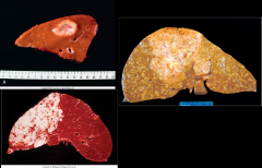 Based on gross appearance, what type of liver cancer is this?

What are some risk factors for this cancer? What is the typical age at presentation and the prognosis?