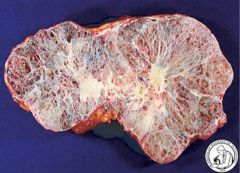 Is this cystic or solid? Benign or malignant? 

What demographic is more commonly seen in?