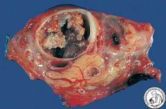What type of neoplasm is this (cystic or solid)?

 How can you distinguish it from a Mucinous Cystadenoma?