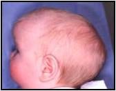 Synostotic scaphocephaly—fusion of the saggital suture

Premature fusing. 

Football shaped head with sagittal