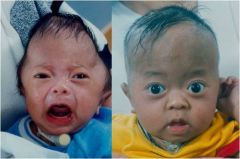 Synostotic trigoncephaly—fusion of the metopic suture