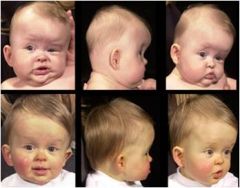 Synostotic brachycephaly—fusion of both coronal sutures Synostotic anterior plagiocephaly—fusion of one coronal suture