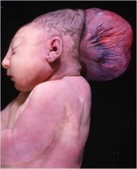 - Malformation involving defective closure of a portion of the neural tube in association with a bony skull defect

- 75% occur occipitally, but lesions have been noted in the frontal and parietal regions