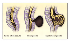 1. Spina bifida occulta
2. Meningocele
3. Myelomeningocele

Meningocele and myelomeningocele are also referred to spina bifida cystica