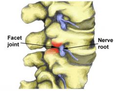 Example: facet joints of vertebrae. Contain fivrous capsule, synovial membrane, etc. Think "pop" joints.