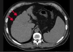 What does this CT show?