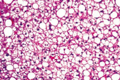 When might you see macrovesicular fatty change in the liver?