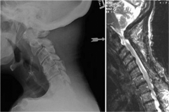 Which variables has the strongest assoc w/ poor clinical outcomes in pts who undergo expansive laminoplasty for cerv spondylotic myelopathy? 1- Multi-level stenosis; 2-Duration of sx; 3- Local kyphosis > 13 deg; 4-Osteopor;5-MRI CSF effacemnt