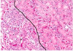 What has happened to the right side of this slide if the left is normal kidney tubules