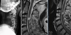 athletes multiple episodes of transient quadriparesis/ b/l ext sx w/MRI evidence of cord injury should be avoid, contact/collsn sports. It was found that the presence of an abn Torg ratio does NOT appear to be predictive of future spinal cord inju...