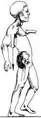 Extension Lurch (also Known as Gluteus Maximus Lurch) to Compensate for Weak Hip Extensors