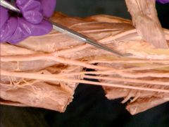 The interosseus  membrane of the forearm is a FIBROUS sheet that connects the radius and the ulna. 

Fibrous joint, subtype syndesmosis 

UMIch: 

Syndesmoses: In this type of joint, apposed bones are joined by a fibrous membrane (interosseo...
