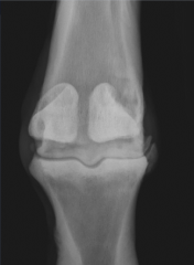 osteophytes
joint space narrowing
sclerosis
soft tissue swelling