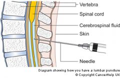 A lumbar puncture (LP) removes a small amount of cerebrospinal fluid (CSF) from the space around the spine for examination under a microscope. CSF is the fluid that surrounds the brain and spinal cord. A lumbar puncture is also called spinal tap a...