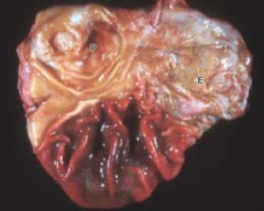 Mdx?
This occurs in ___ conditions in swine where ___ lodge in the submucosal gastric vessels → 
Thrombosis
Infarction
Ulceration
