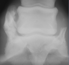 ossification of collateral cartilages

usually not clinically significant
most common in draft breeds

radiographic findings:
-edge of ossified collateral cartilage extends beyond proximal margin of navicular bone
-asymmetric mineralization...