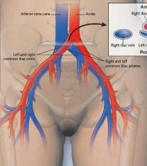 right and left Common Iliac Arteries