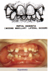 - 3rd Molars


- Maxillary Lateral incisors


- Mandibular 2nd premolar


Least often missing: Permanent canines