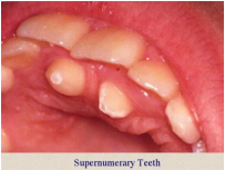 3rd molar area


Mesiodens


Mandibular premolar area