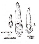 Macrodontia


Microdontia:
- Peg lateral incisors
- Small 3rd molars