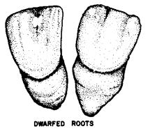 Dwarfed roots


Permanent maxillary central incisors