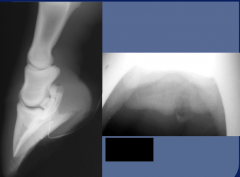 Infection

secondary to puncture wound (nail, foreign object)

radiograph may be normal at time of injury - if recent possibly seen avulsion fracture

additional imaging with positive (iodinated) contrast agent should be considered (sinograp...