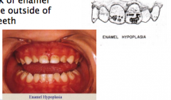 Enamel Hypoplasia


-Genetic amelogenesis imperfecta is a type of Enamel hypoplasia due to defects in the ameloblasts