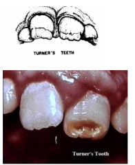 Dental Fluorosis - Mottling


Turner's tooth