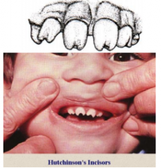 Hutchinson's teeth