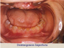Hereditary dentinogenesis imperfecta