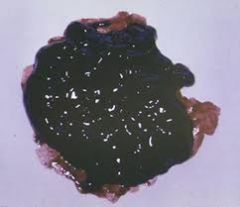 Black, tarry, liquid, foul-smelling stool
-- caused by degradation of hemoglobin by bacteria in the colon-- presence of melena indicates that blood has remained in the GI tract for several hours
- the further the bleeding site is from the rectum...