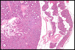 Most common
composed primarily of chief cells with some islands of oxyphil cells
Loss of normal adipocytes
A rim of compressed normal parathyroid at periphery (on right in image)