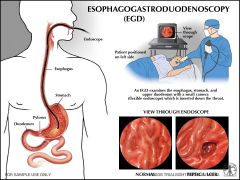 esophagogastroduodenoscopy (EGD/upper endoscopy) with coagulation of the bleeding vessel. If the bleeding continues, repeat endoscopic therapy or proceed with surgical intervention (ligation of the bleeding vessel)