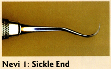Sickle-end of the Nevi 1 instrument
Rigid shank
small, thin sickle
Use on coronal surfaces of anterior teeth