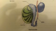 it is the term given to varicosities of the pampiniform venous plexus running along the spermatic cord