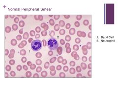 Peripheral Smear

-Want to look at RBCs, platelets and nucleated cells in the frame

-RBCs should have 1/3 of cell being pale, darker in periphery

-All should be around same size and shape

-10 platelets per high powered field is normal range...