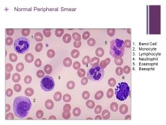 Normal smear that happens to have all the cells that could be in the smear

-RBCs are all relatively the same size.

Monocyte (kidney bean shape – fair amount of cytoplasm)

Eosinophils are not common to see in a smear, basophils even less so...
