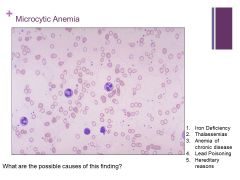 MCV <70fL!

Possible causes listed

Major signs and symptoms are fatigue and pallor (admittedly vague)

Widened area of pallor visible in the RBC (should only be 1/3 of the cell)

Furlong thinks this could be a transfused patient because there...